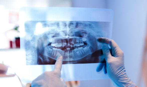 Dental X-Ray to show Patient Treatment Plans