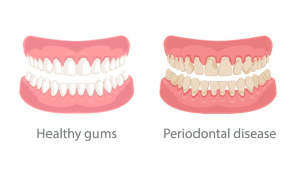 Show the difference between healthy teeth and teeth with Perio Disease