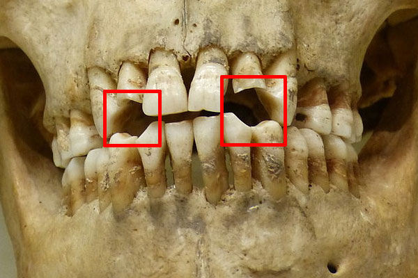 Teeth that have been worn down due to pipe smoking.