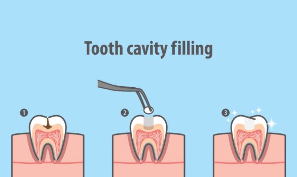 How a cavity develops
