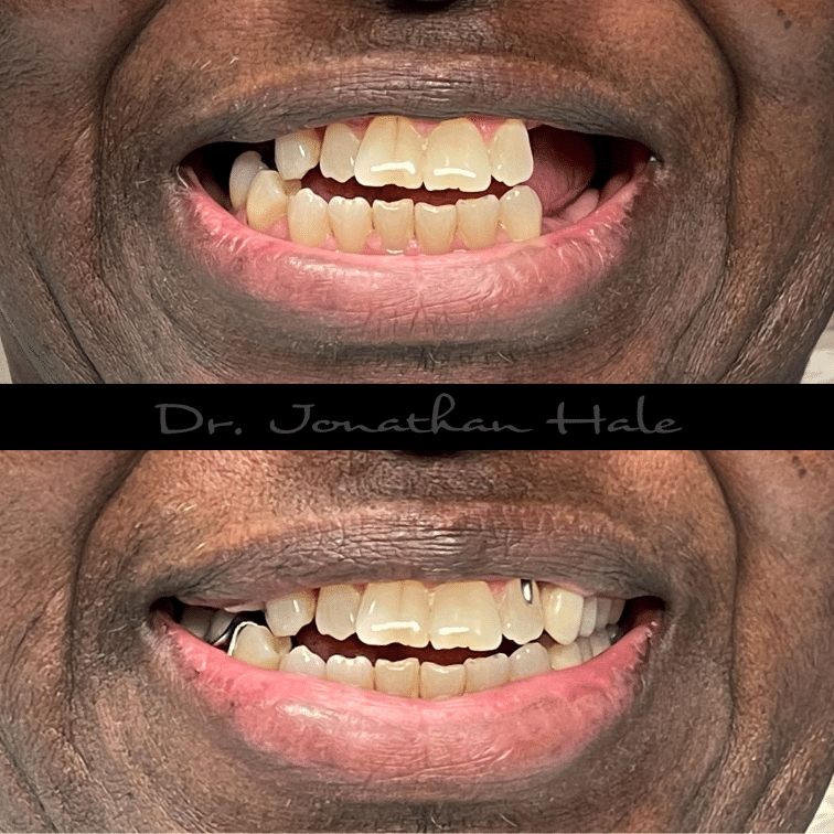 Before and After Dental Partials
