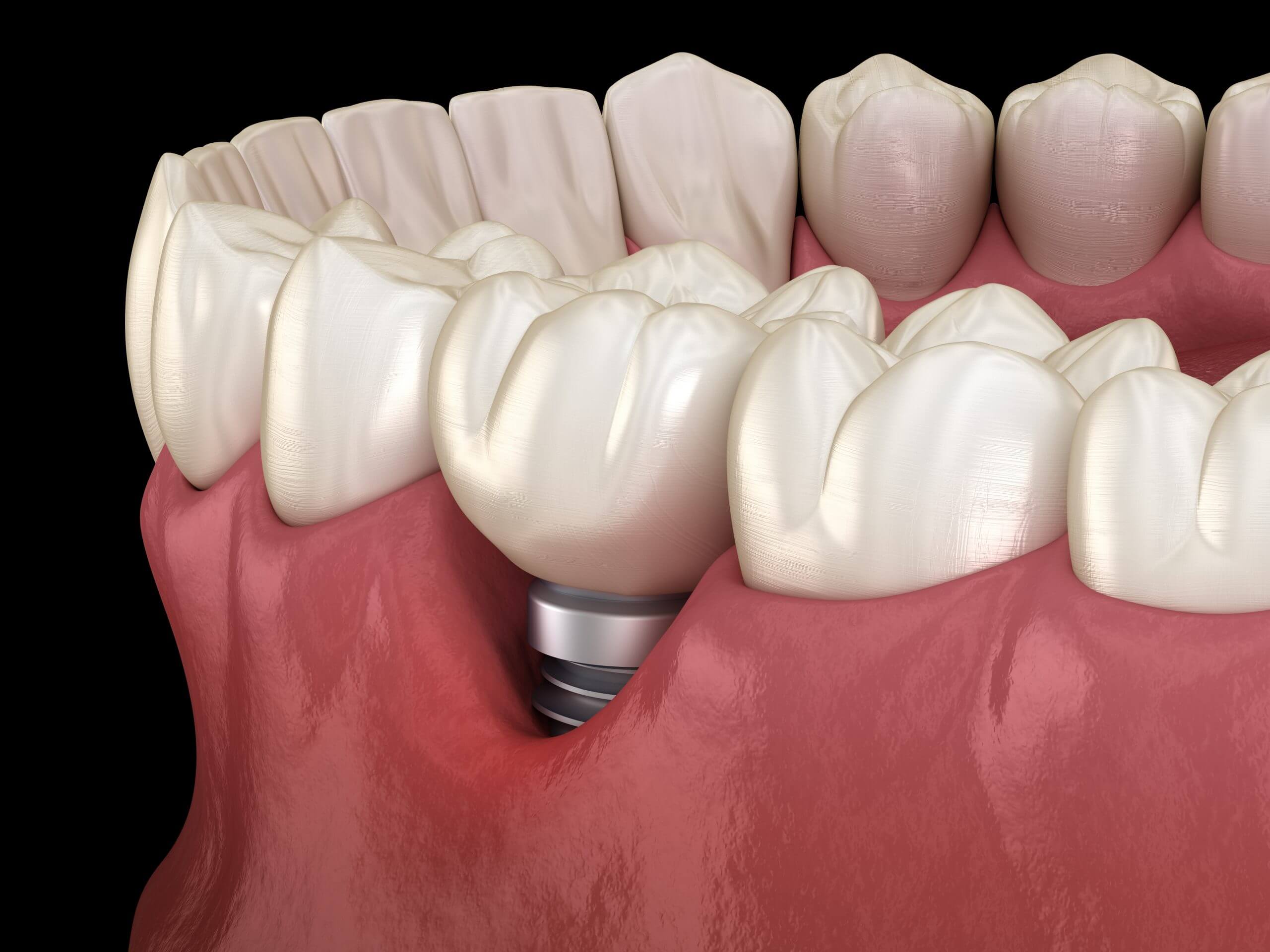 Dental Implant Perio Implantitis