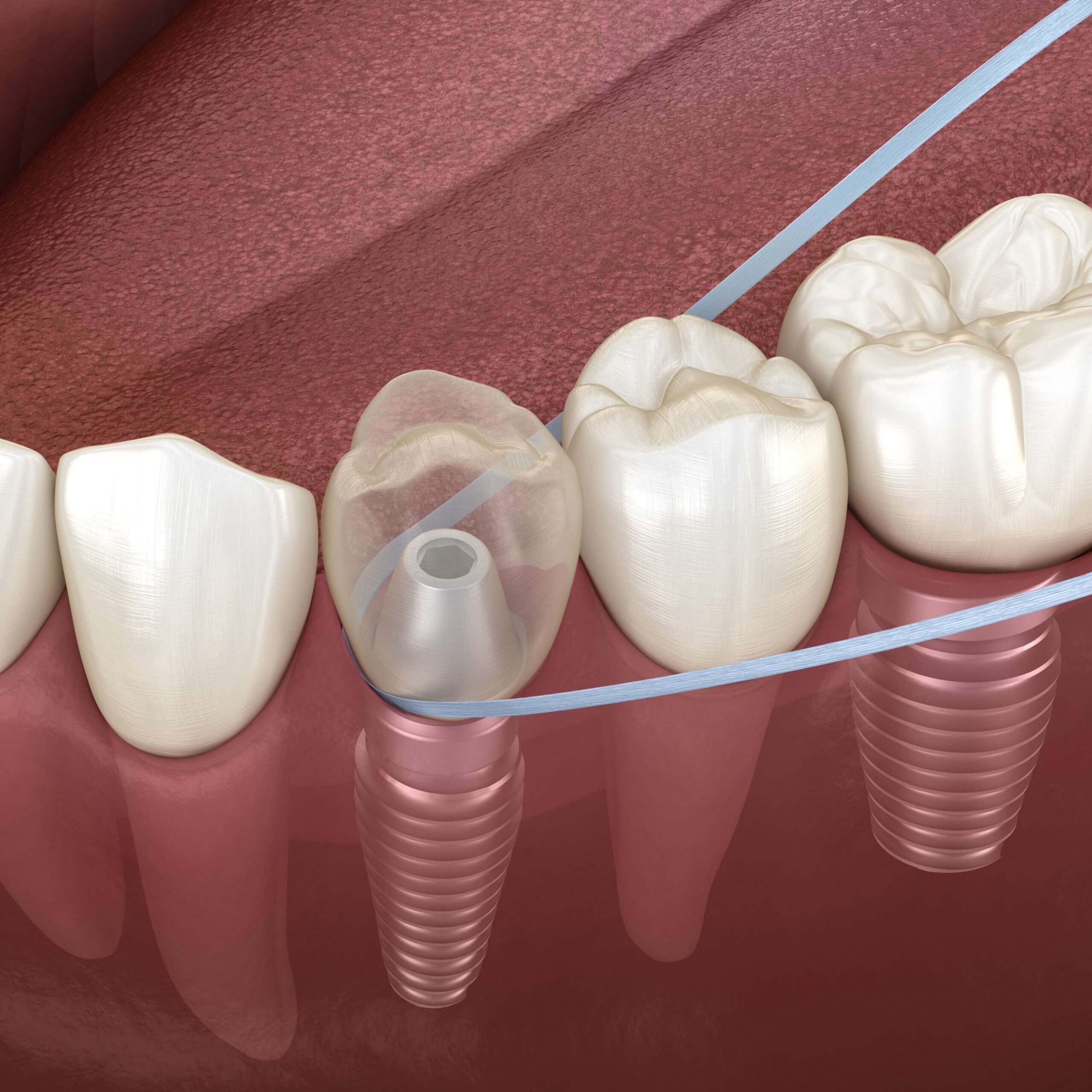 Floss Dental Implant 03