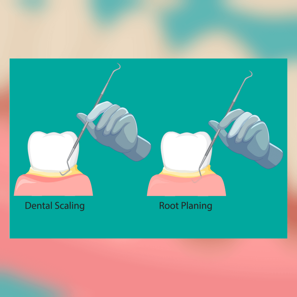 Dental Scaling & Root Planing illustration with tooth and scaler