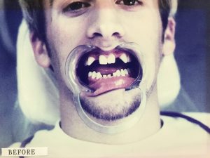 Dentist with Congenital Dental Defects called Oligodontia