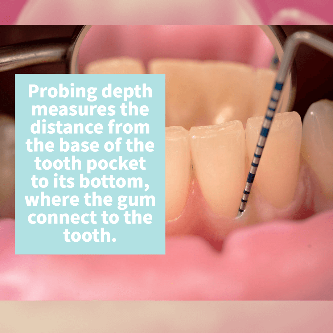 Probing depth explained in an image which is the base of the tooth pocket to its bottom.