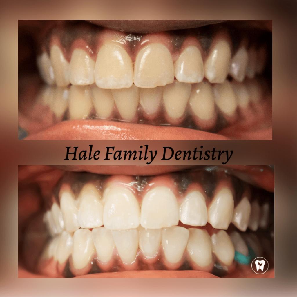 Teeth Whitening at Hale Family Dentistry in Fort Wayne, Indiana