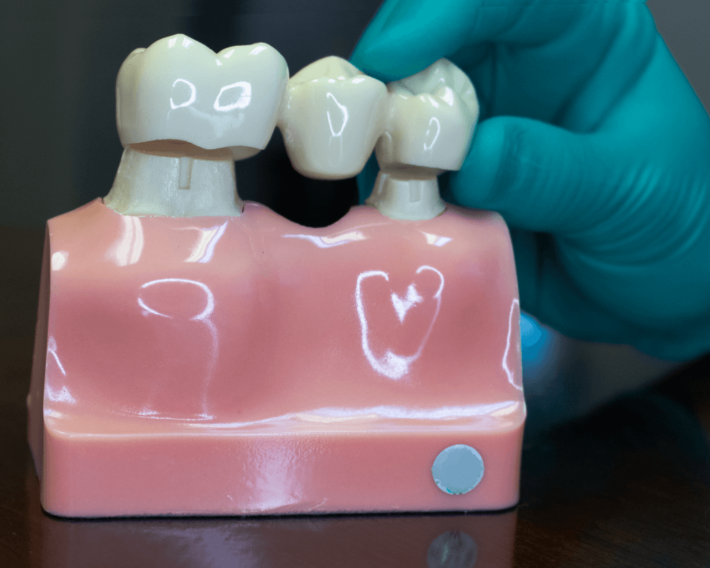 top-tooth-replacement-options-dental-bridge-hale-dental-care