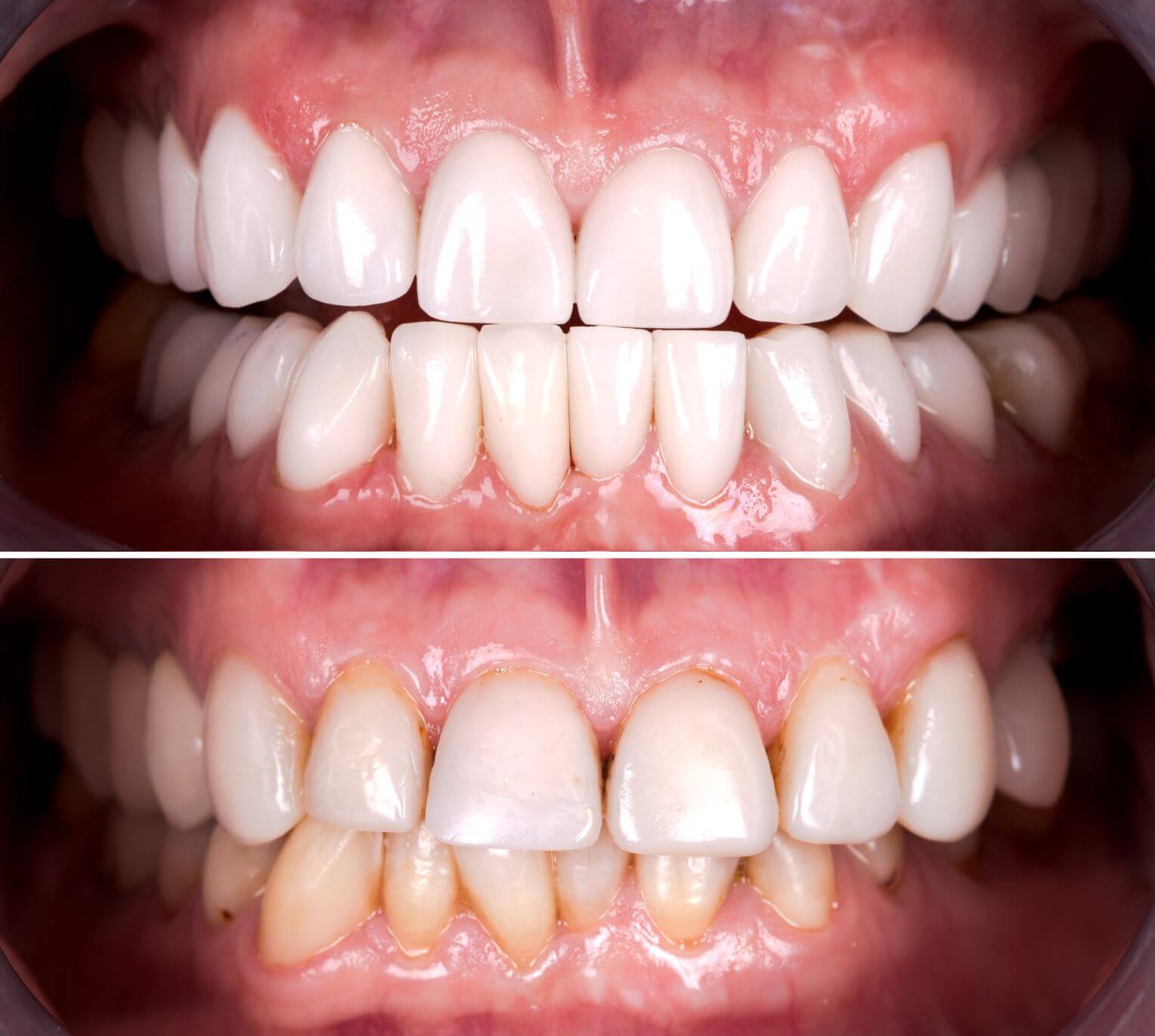 dental crown before after