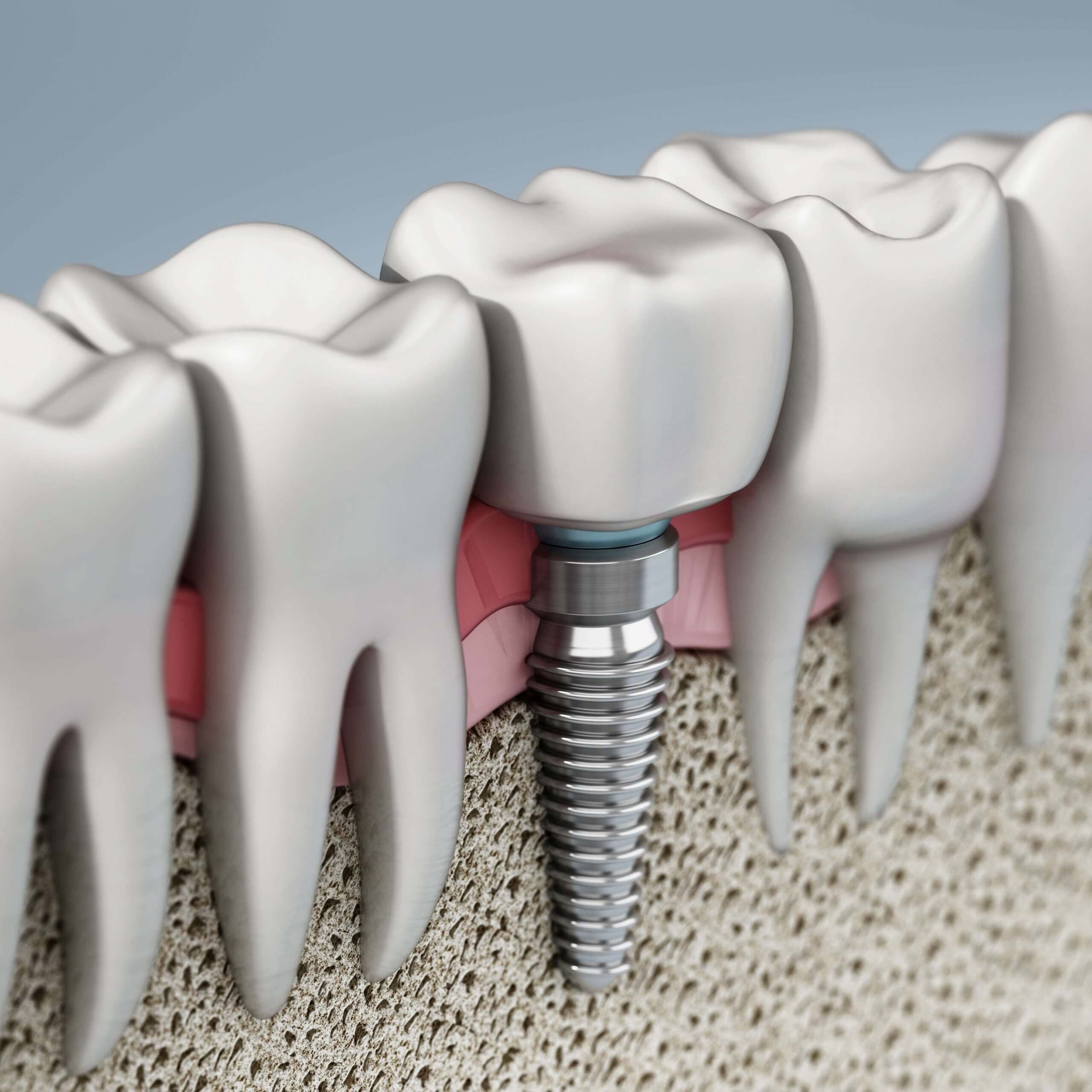 graphic illustration art showing a dental implant beside natural teeth and how the screw like part of the implant is placed in the bone of the mouth.
