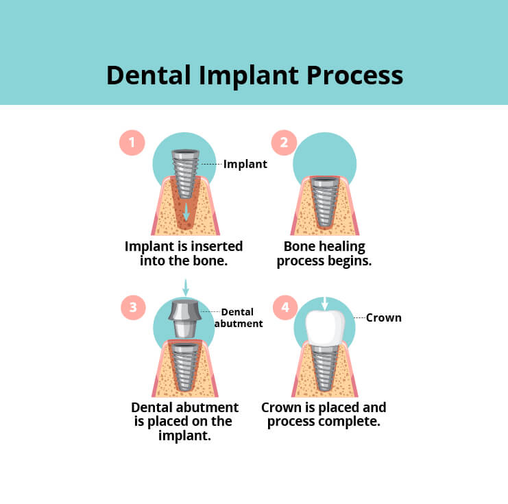 an illustration graphic that helps visualize the dental implant process including bone implantion, healing, and the final restoration of dental abutment and dental crown.