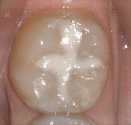 dental sealants 17