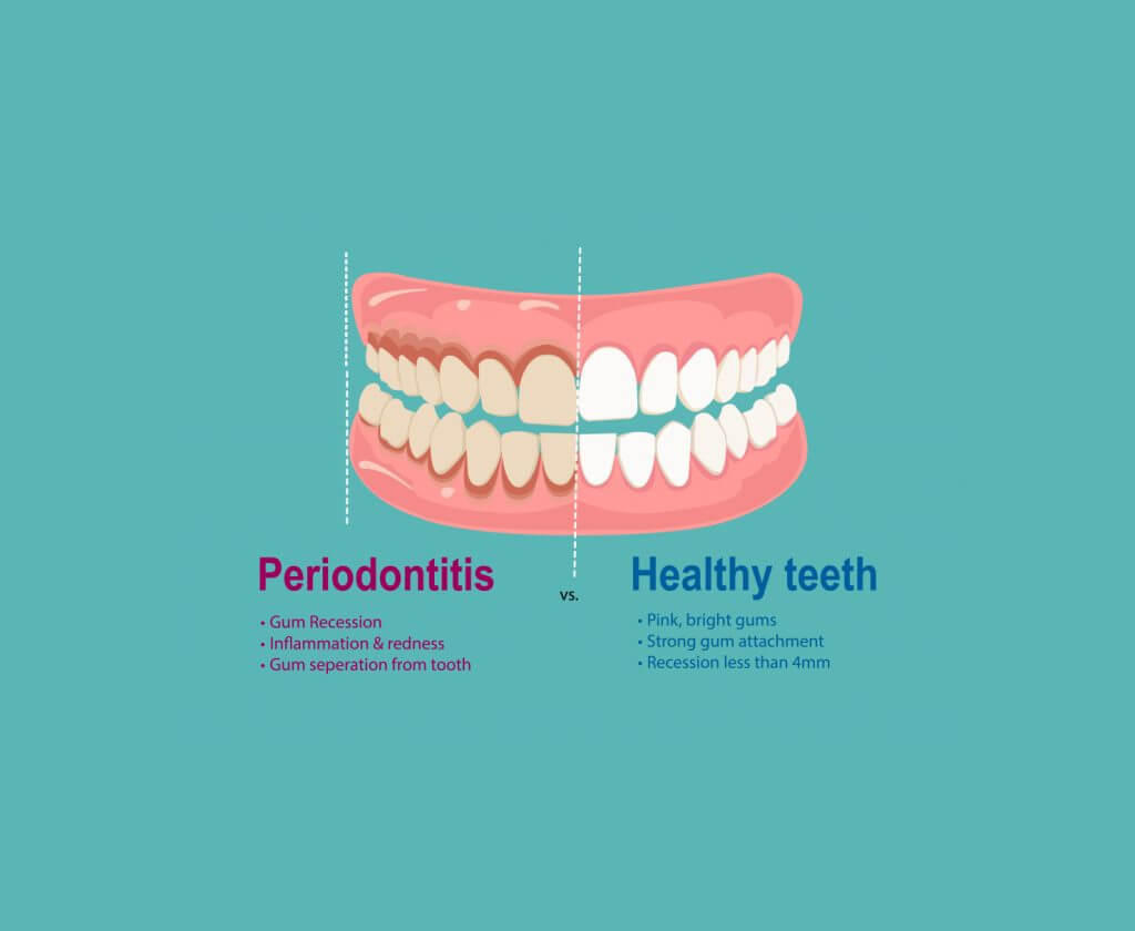 periodontal maintenance graphic